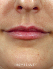 Dr. Kenneth R. Beer - The Art of Lip Enhancement - Before