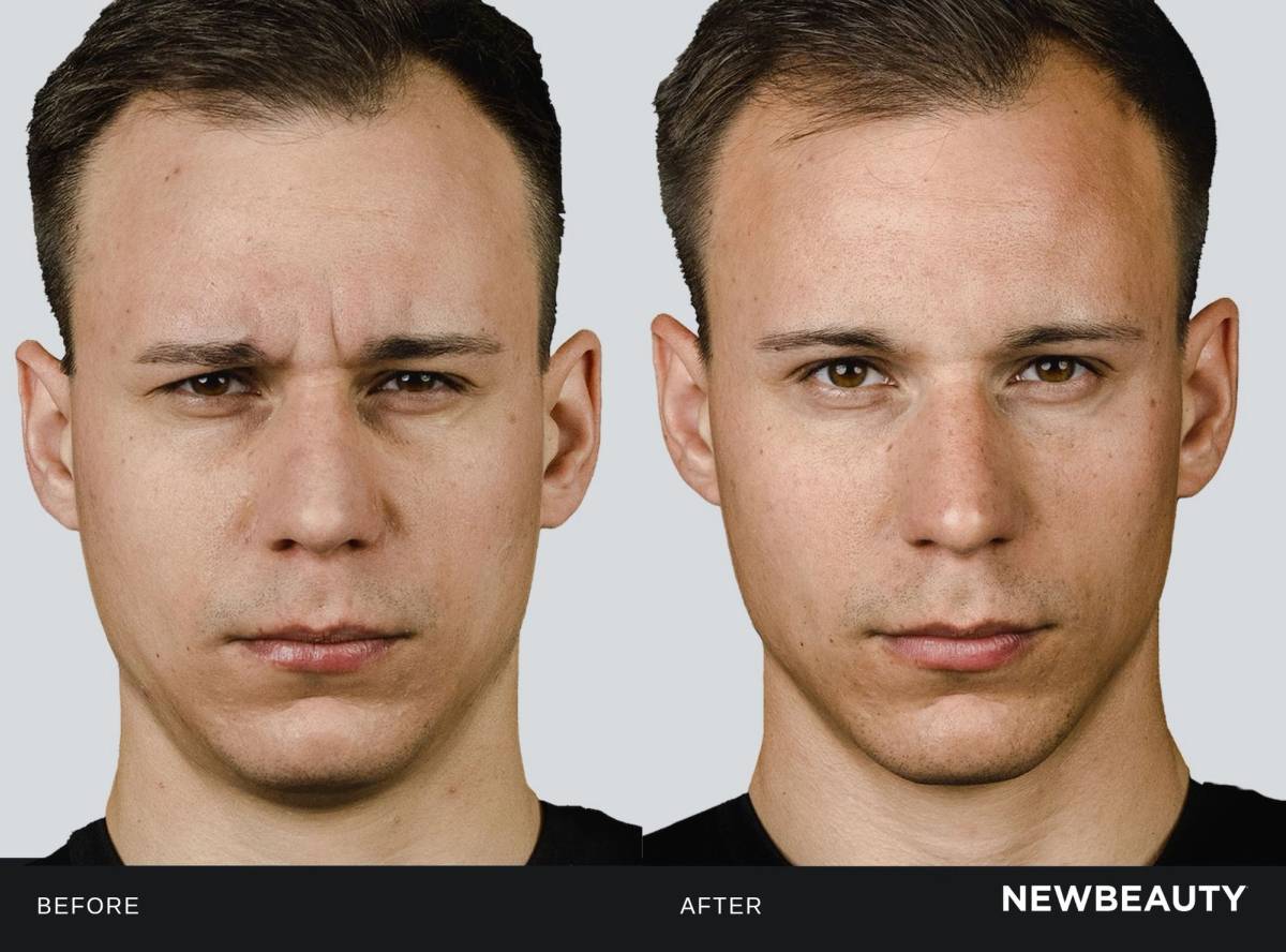 Male patient before and four weeks after Letybo treatment for glabellar lines