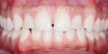 Dr. Nathan Hoffman - Invisalign - Before