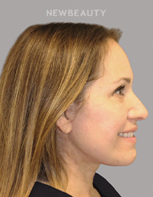 Dr. Amit Arunkumar-Facelift-53172928 - After