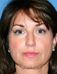 Dr. Kelly Bomer Liquid Facelift - After