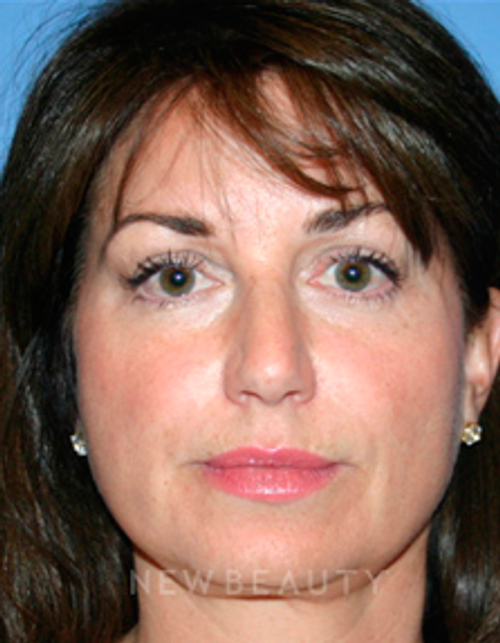 Dr. Kelly Bomer Liquid Facelift - After