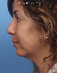 Dr. James Bouzoukis - Restylane - Before