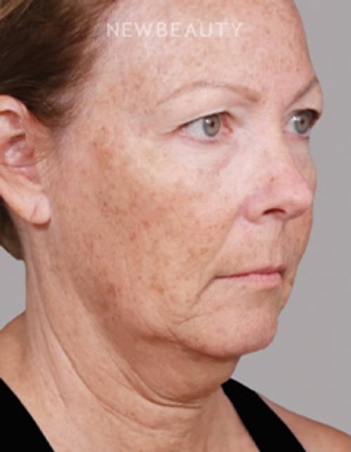 Dr. Paul Nassif - Facelift, Necklift, Upper Blepharoplasty - 51350740 - Before