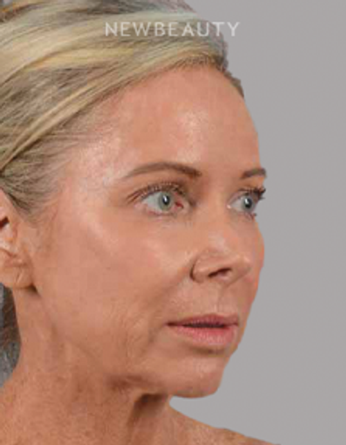 Dr. Henry A. Mentz - Full-Face Rejuvenation - Before