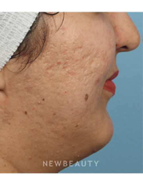 Dr. Kathleen Behr - Microneedling - Before