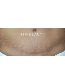 Dr. Kenneth Beer Fraxel Stretchmarks - After