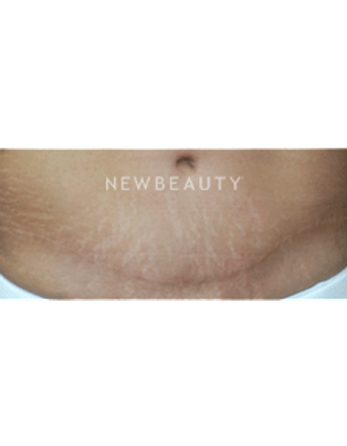 Dr. Kenneth Beer Fraxel Stretchmarks - After