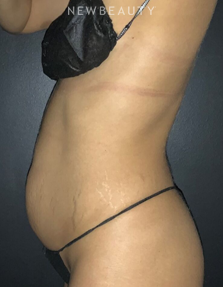 Dr. Janet Allenby - CoolTone - Before