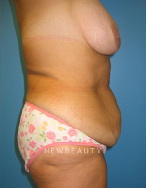 Dr. Christine Hamori Tummy Tuck - Before