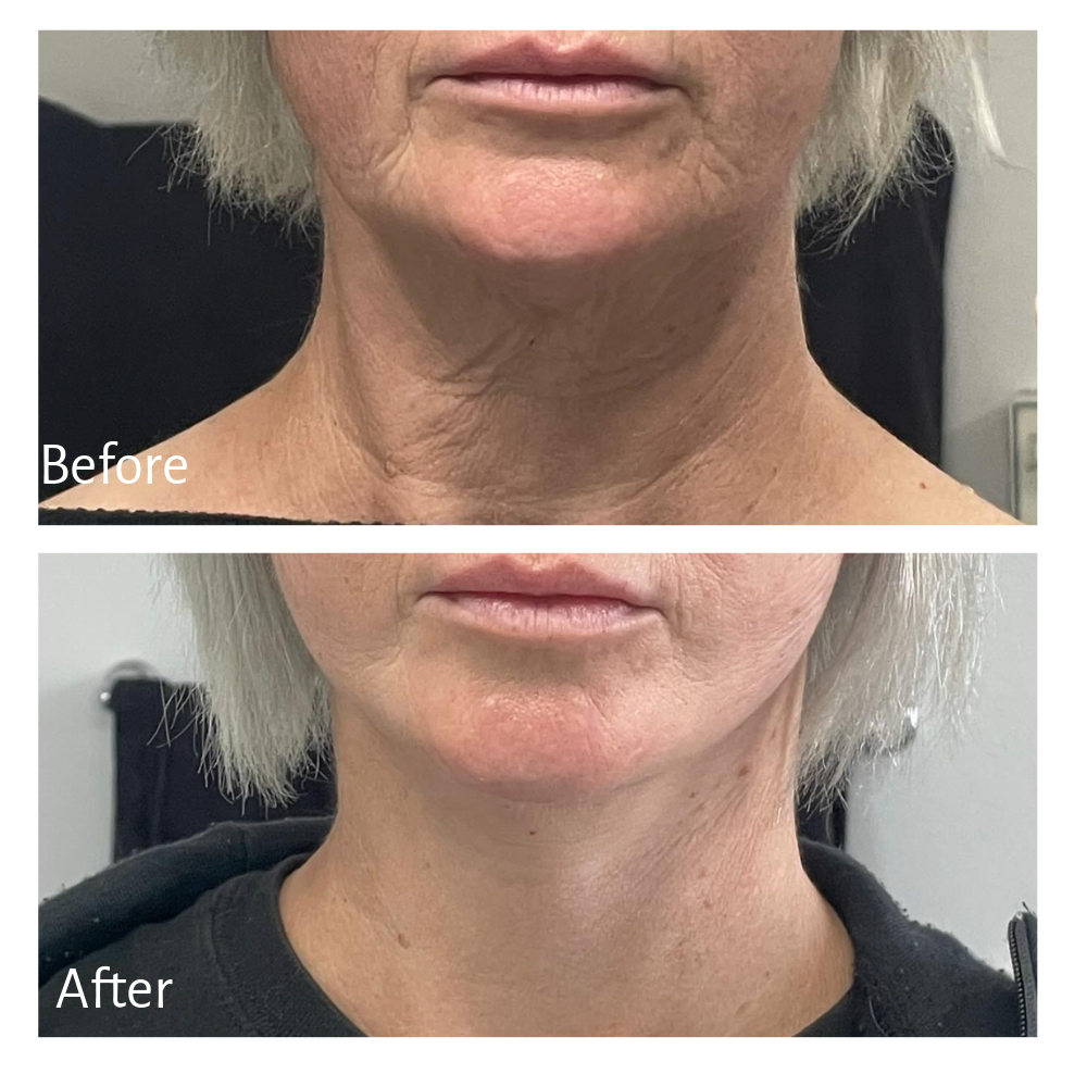 Treatment: Facelift
