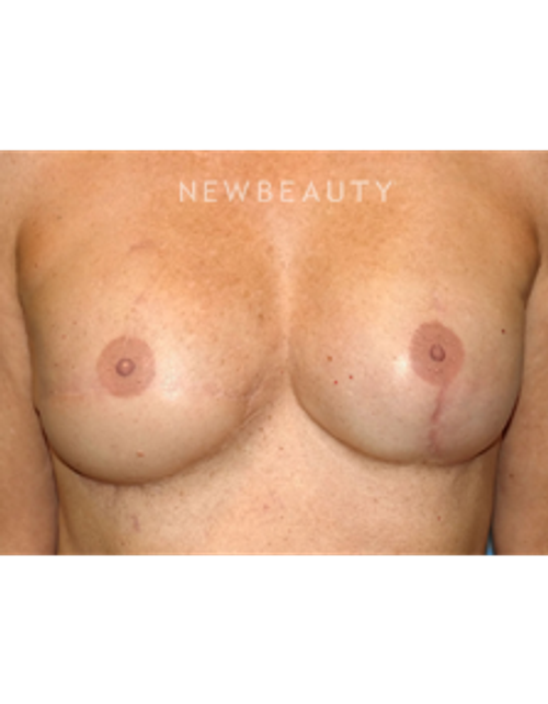 Dr. Bryan Gawley - Breast Reconstruction - After
