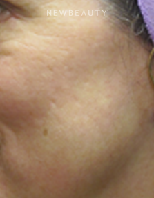 Dr. Jody Levine - Lasers - After