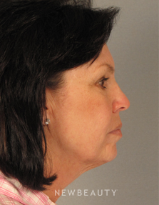 Dr. Mentz, Facelift & Necklift - Before