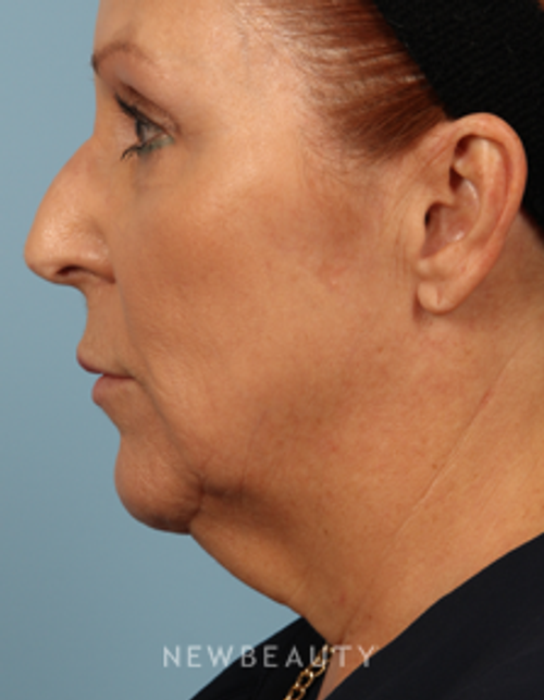 Dr. Carmen M. Kavali - Contour Correction - Before