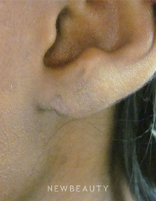Dr. Kally Papantoniou - Earlobe Repair - After