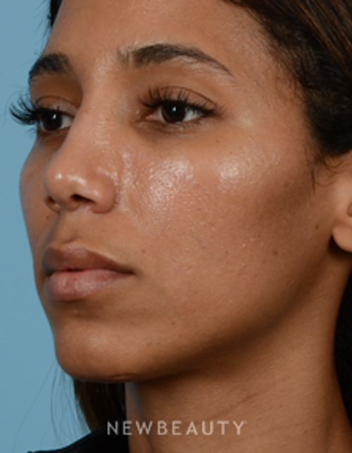 Dr. Jeffrey B. Wise - Nasal Tip Refinement - After