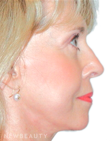 Dr. Henry Mentz Facelift - After