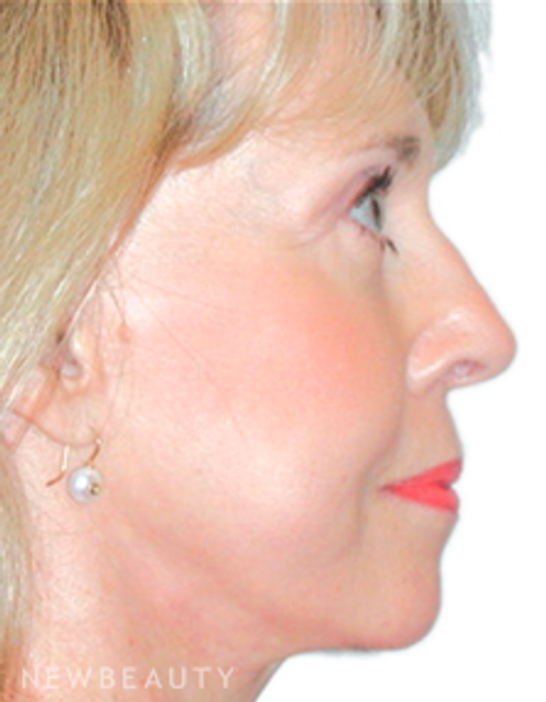 Dr. Henry Mentz Facelift - After