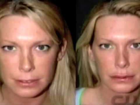 Dr. Jacono – Lip Augmentation