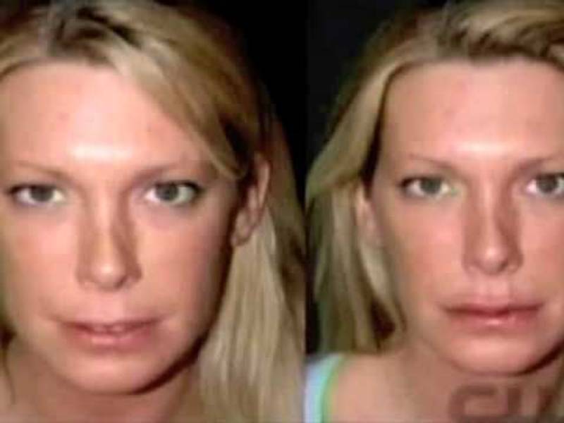 Dr. Jacono – Lip Augmentation
