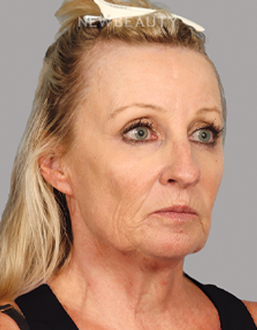 Dr. Mahabir - Facelift - 20637984 - Before
