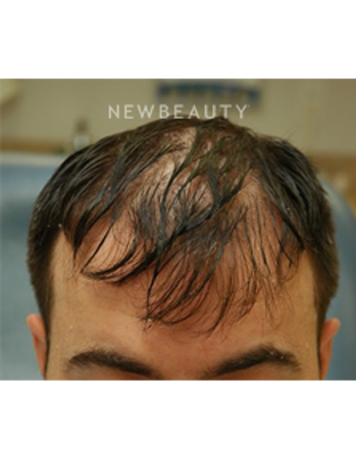 Dr. Jeffrey Rapaport - Hair Transplant - Before
