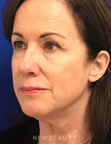 Dr. Dilip Madnani - Facelift - Before