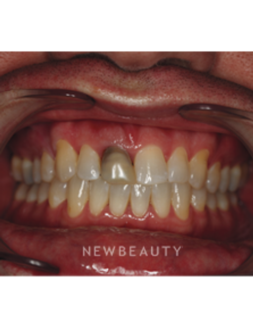 Dr. Neal Patel - Dental Implant - Before
