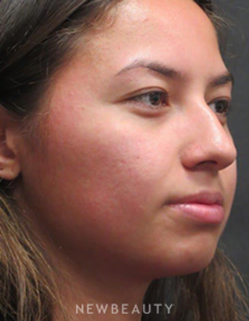 Dr. Elie Levine - Rhinoplasty - Before