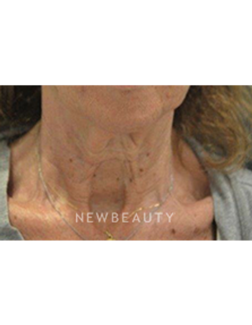 Dr. B. Aviva Preminger - Neck Lift - Before