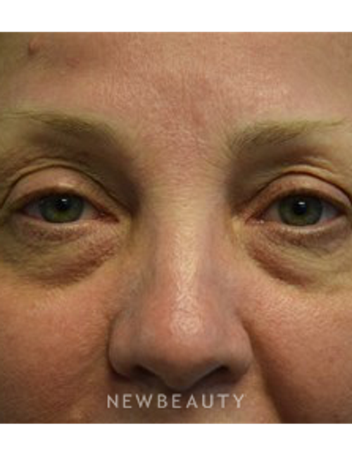 Dr. Jeffrey B. Wise - Eyelift - Before