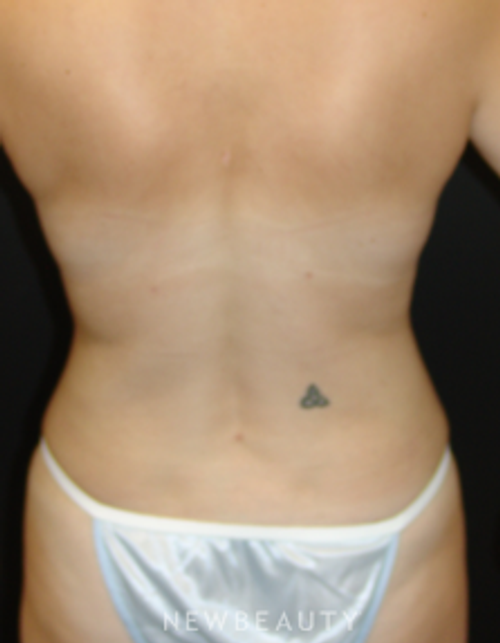 Dr. Mokhtar Asaadi - VASER Lipo - After