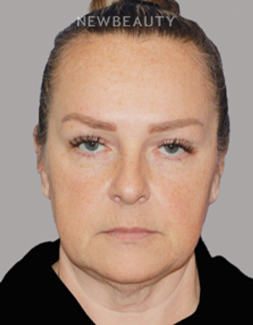 Dr. Konstantin Vasyukevich – Deep Plane Face and Neck Lift – 46903887 - Before