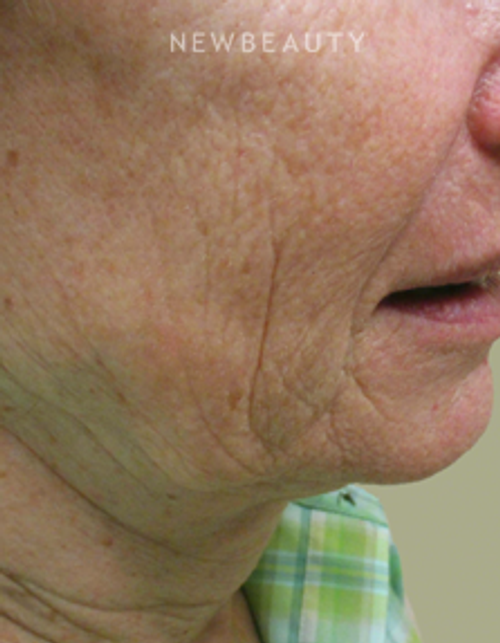 Dr. Kally Papantoniou - Ulthera - Before