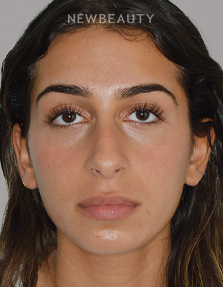 Dr. Anthony Bared - Rhinoplasty - 46164855 - Before