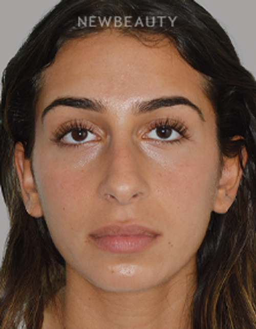 Dr. Anthony Bared - Rhinoplasty - 46164855 - Before