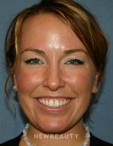 Dr. Kelly Bomer, Injections/Liquid Lift - Before