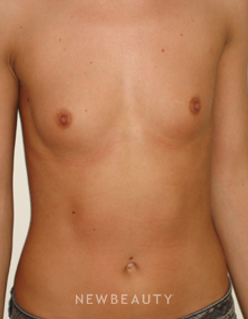 Dr. Michael Horn Breast Augmentation - Before