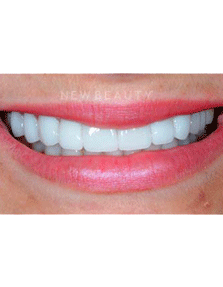 Dr. Guy Lewis Veneers - After