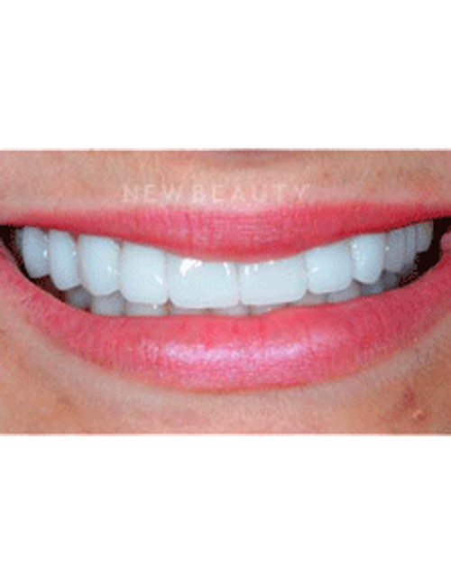 Dr. Guy Lewis Veneers - After