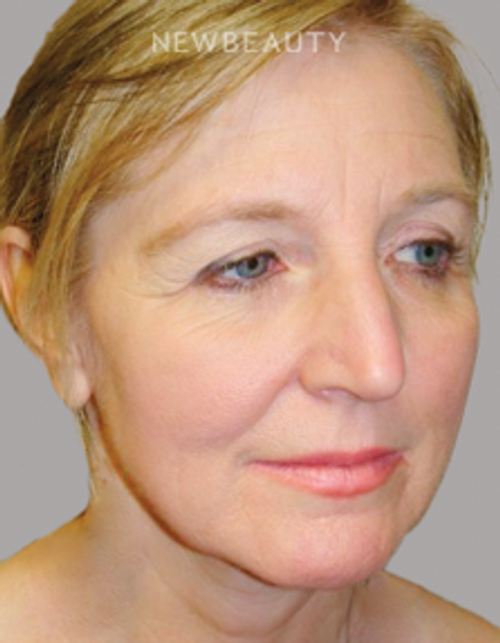 Dr. Sanjay Grover - Facelift - 49726554 - Before