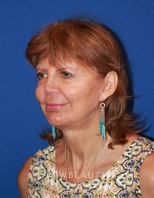 Dr. Dilip Madnani - Facelift - After