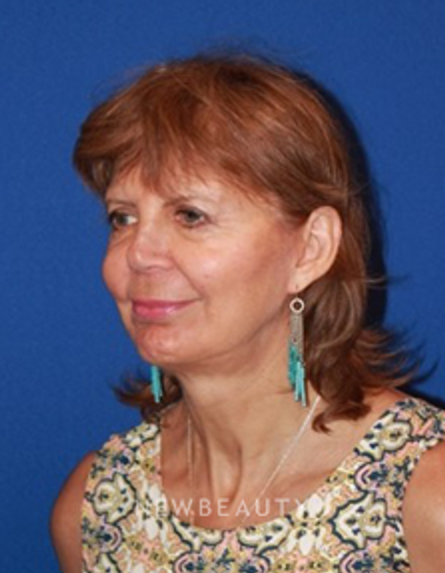 Dr. Dilip Madnani - Facelift - After