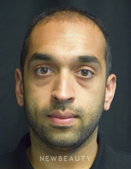 Dr. Jeffrey B. Wise - Hair Transplant - After