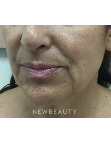 Dr. Julie Russak - Lower Facelift - Before