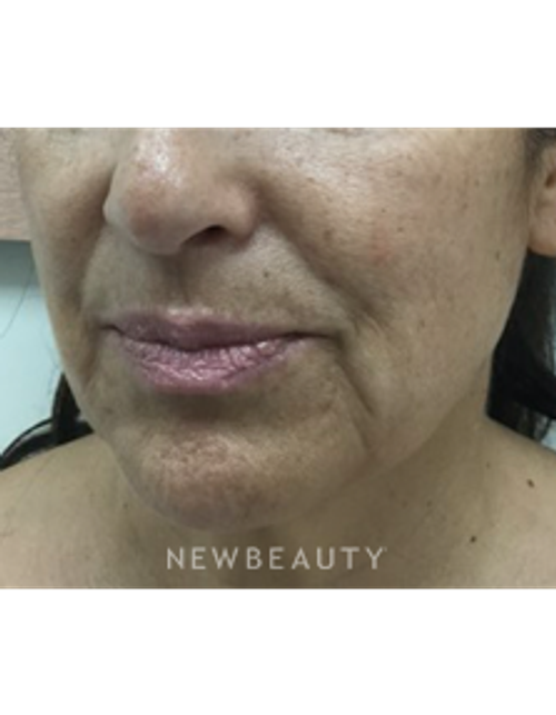 Dr. Julie Russak - Lower Facelift - Before