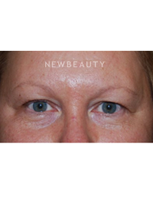 Dr. Roman Rayham - Total Eye Rejuvenation - Before