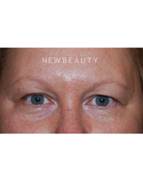 Dr. Roman Rayham - Total Eye Rejuvenation - Before