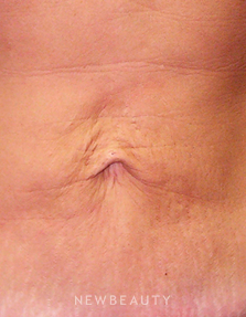 Dr. Ruth Hillelson Skin Tightening, Energy-Based - Before